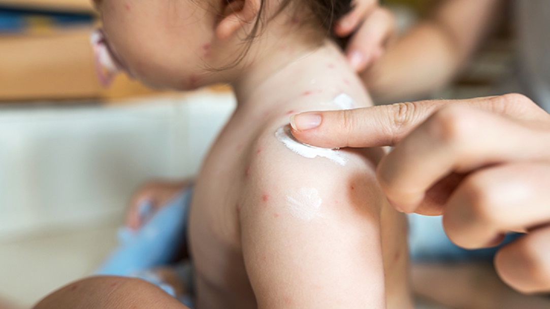 Dealing with Common Baby Skin Conditions